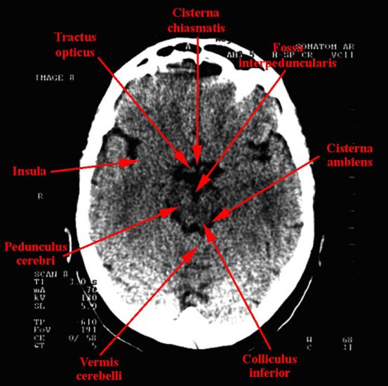 tomografia komputerowa głowy - 07b.jpg